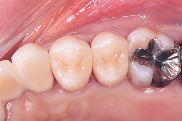 セラミッククラウン