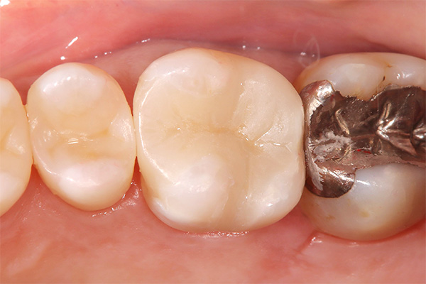 セラミックインレー