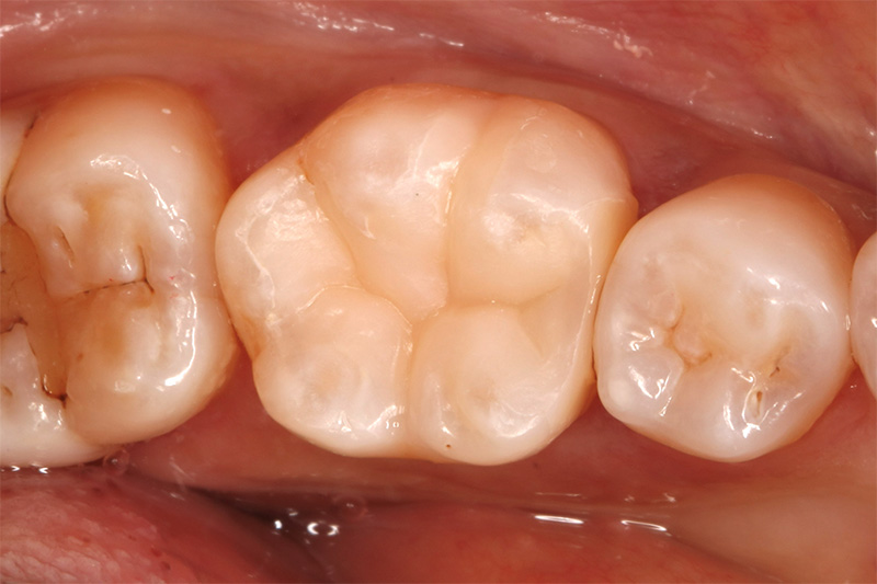 ダイレクトセラミックス症例1