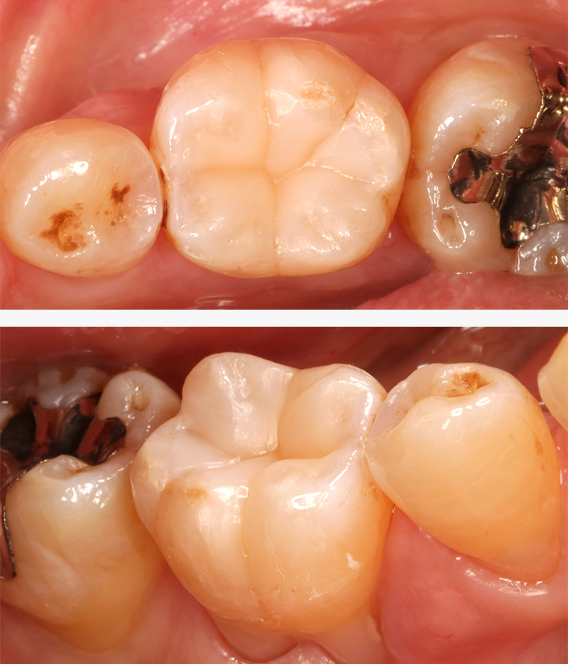 ダイレクトセラミックス症例2