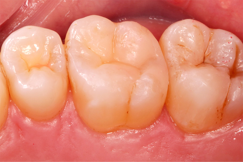 ダイレクトセラミックス症例4