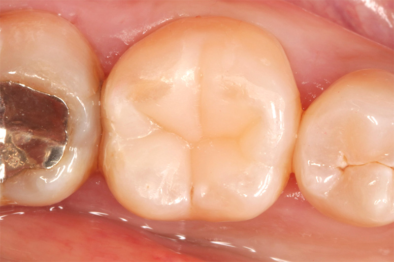 ダイレクトセラミックス症例5