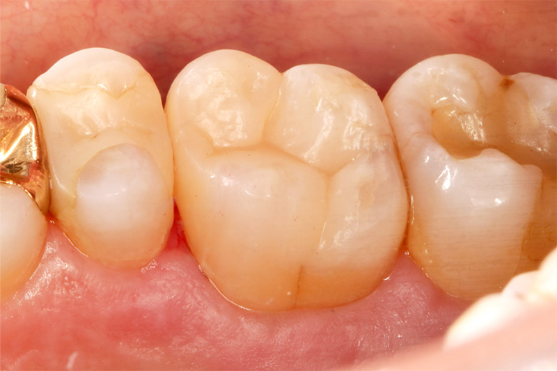 ダイレクトセラミックス症例6