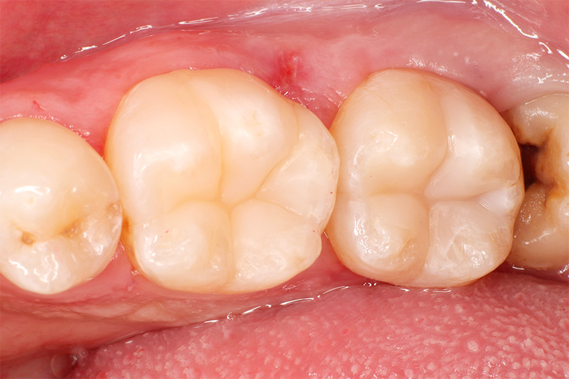 ダイレクトセラミックス症例8