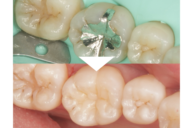 ダイレクトセラミック治療