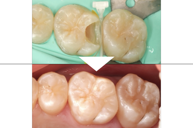 ダイレクトセラミック治療