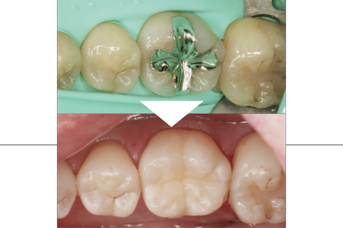 ダイレクトセラミック治療