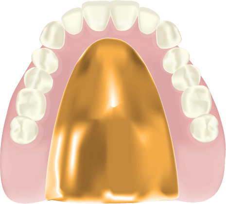 ゴールド床義歯